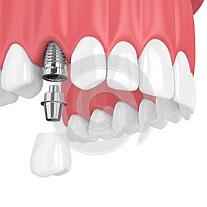 3d render of upper jaw with teeth and dental premolar implant