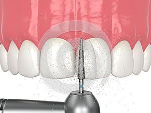 3d render of using a dental drill to shape the tooth and remove excess resin