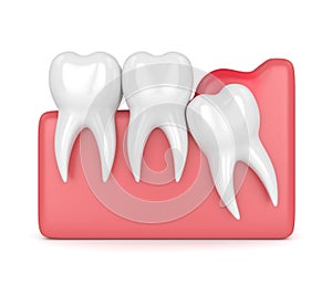 3d render of wisdom mesial impaction with pericoronitis