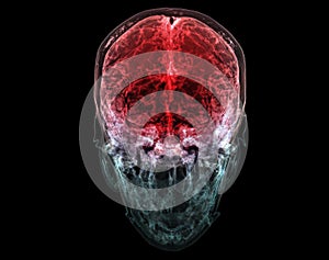 3D rendered medically accurate illustration of the cerebral artery of the head