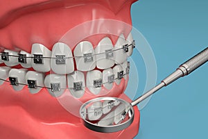 3D rendering from a dental brace check with a stomatoscope