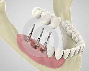 3D rendering teeth