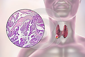 A 3D scientific illustration showcasing a human body with transparent skin, revealing a tumor in his thyroid gland