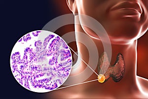 A 3D scientific illustration showcasing a human body with transparent skin, revealing a tumor in his thyroid gland