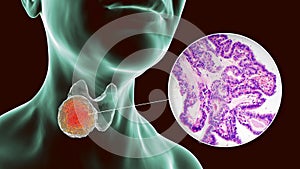 A 3D scientific illustration showcasing a human body with transparent skin, revealing a tumor in his thyroid gland