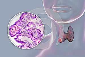 A 3D scientific illustration showcasing a human body with transparent skin, revealing a tumor in his thyroid gland