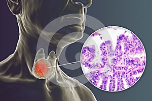 A 3D scientific illustration showcasing a human body with transparent skin, revealing a tumor in his thyroid gland