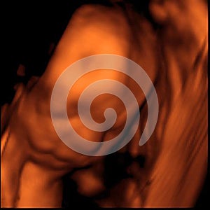 3D Sonogram