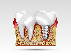 3d teeth in a cut with nerve endings.