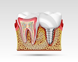 3d teeth in a cut with nerve endings.