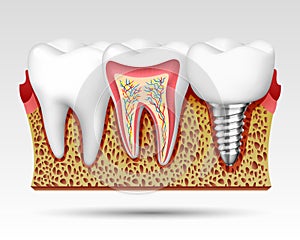 3d teeth in a cut with nerve endings