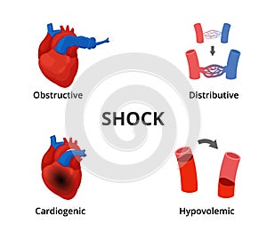 4 types of shock diagram. Medical emergency infographics