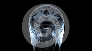 4K Brain MRI scan with tumor neoplasm medical research .