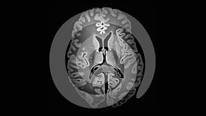 4K Brain MRI scan with tumor neoplasm medical research sagittal post contrast sequence