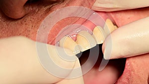 4K Close-up shot of installing ceramic crown and dental veneers on incisor