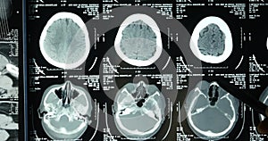 4k Doctors study skull brain X-ray film for analysis.health medical hospital.