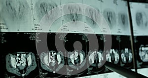 4k Doctors study skull brain X-ray film for analysis.health medical hospital.