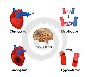 5 types of shock infographics. The diagram with the illustrations of five types of shock