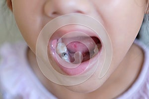 6 year old girl`s tooth decay and wound tongue. F