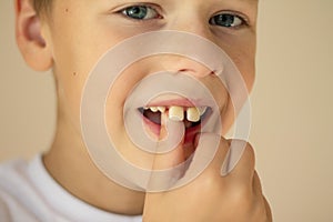 A 7-10 boy in a white T-shirt reels a falling tooth with his finger on a beige background