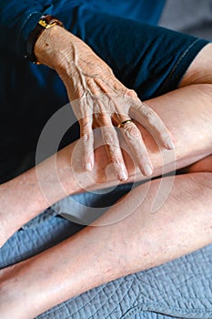 80 years old woman hands with ostheo arthritis, swollen hands and finger, joint inflammation