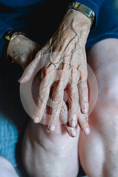 80 years old woman hands with ostheo arthritis, swollen hands and finger, joint inflammation