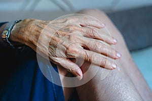 80 years old woman hands with ostheo arthritis, swollen hands and finger, joint inflammation