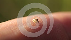 Abandoned bee sting in the human body makes movements, releasing a poison vial.