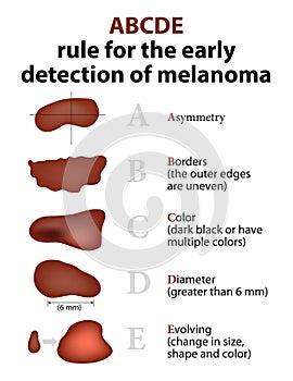 The ABCD rules of Skin Cancer