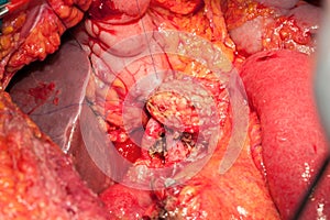 Abdomen arteries and veins with pancreas