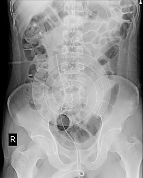 Abdomen showing DJ stent in right ureter.medical image