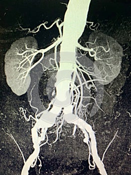 Abdominal aorta aneurysm rc iliac artery aneurysm
