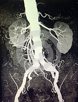 Abdominal aorta aneurysm rc iliac artery aneurysm