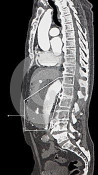 Abdominal Aortic Aneurism. Thrombus. CT-scan reconstruction