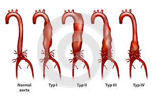 Abdominal aortic aneurysm