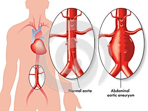 Abdominal aortic aneurysm photo