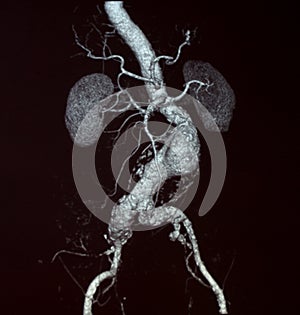 Abdominal Aortic Aneurysm, CT photo