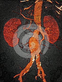 Abdominal aneurysm illustration, CT photo
