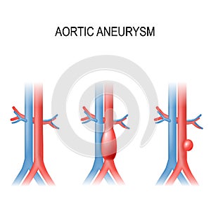 Abdominal aortic aneurysm
