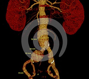 Abdominal aortic infrarenal iliac artery aneurysm aneurysmata