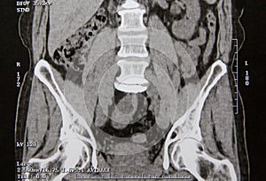 Abdominal CT scan