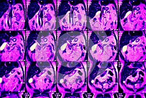 Abdominal MRI, several coronal images photo