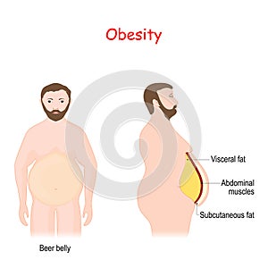 Abdominal obesity. Visceral and subcutaneous fat photo