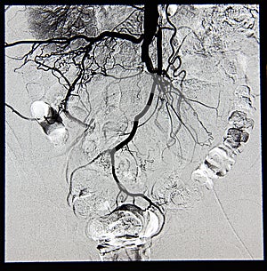 Abdominal and pelvic angiography, vessels