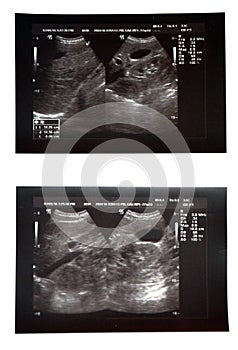 Abdominal pelvic sonography