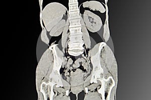 Abdominal xray image Gallstone patients photo