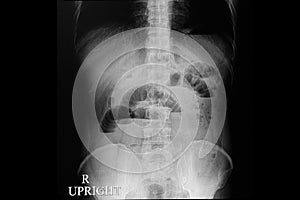 abdominal xray film of a patient with small bowel obstruction