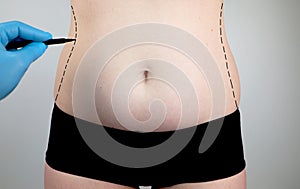 Abdominoplasty and torsoplasty: abdominal liposuction and removal of the apron. The patient at the reception at the plastic photo