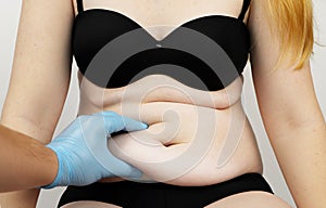 Abdominoplasty and torsoplasty: abdominal liposuction and removal of the apron. The patient at the reception at the plastic photo