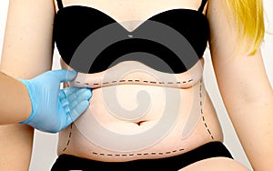 Abdominoplasty and torsoplasty: abdominal liposuction and removal of the apron. The patient at the reception at the plastic